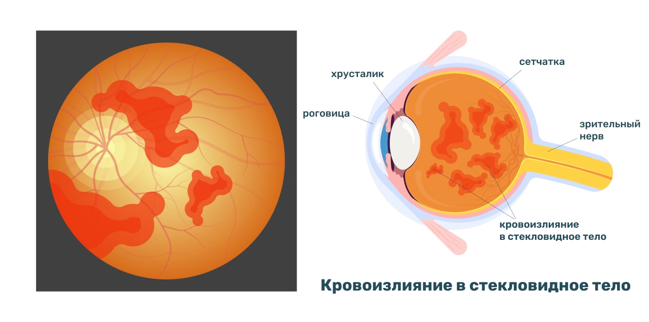 Субретинальное кровоизлияние в сетчатку глаза - причины и лечение