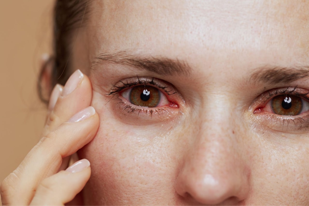 Лечение синдрома сухого глаза