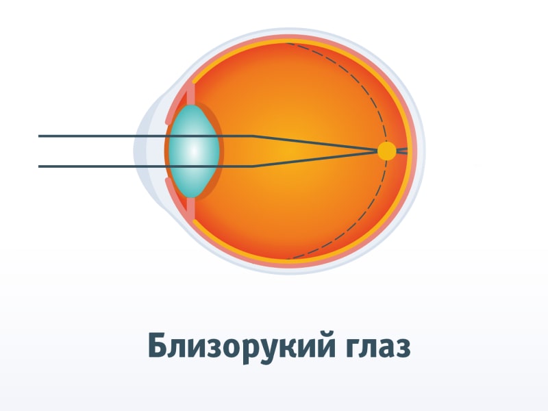 Близорукость глаза (миопия)