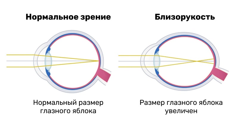 Близорукость (миопия) - строение глаза