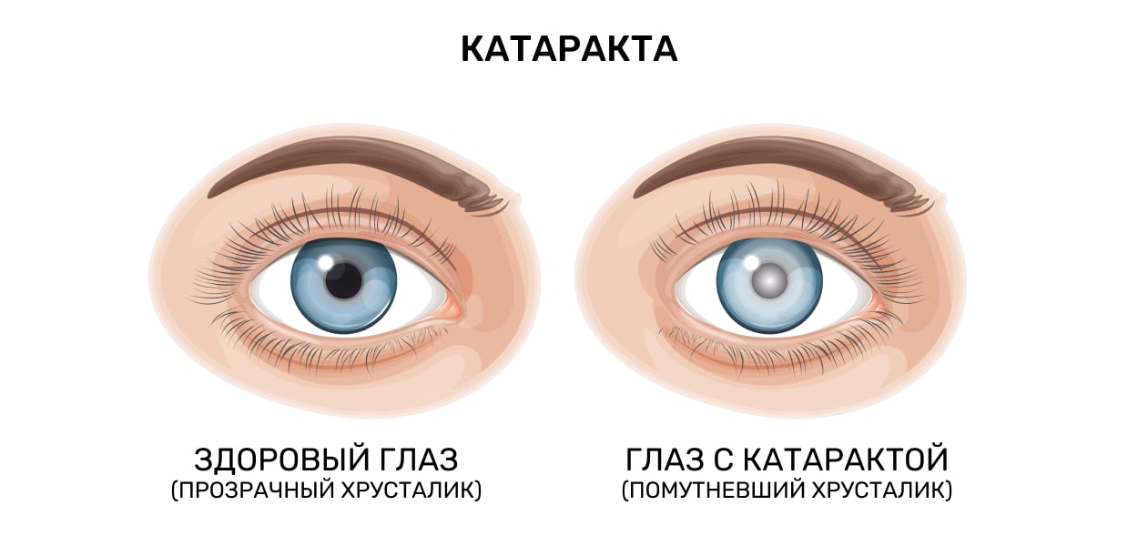 Заболевания глаз — Википедия