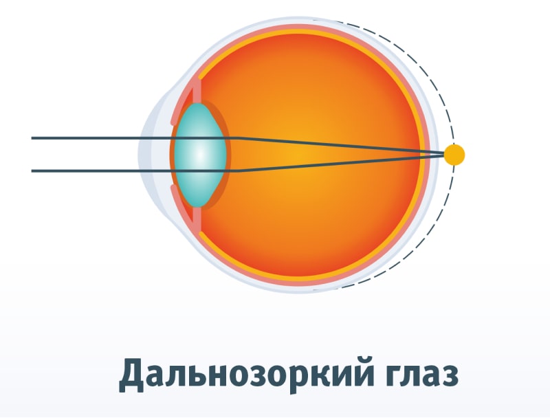 Дальнозоркость глаза (гиперметропия)