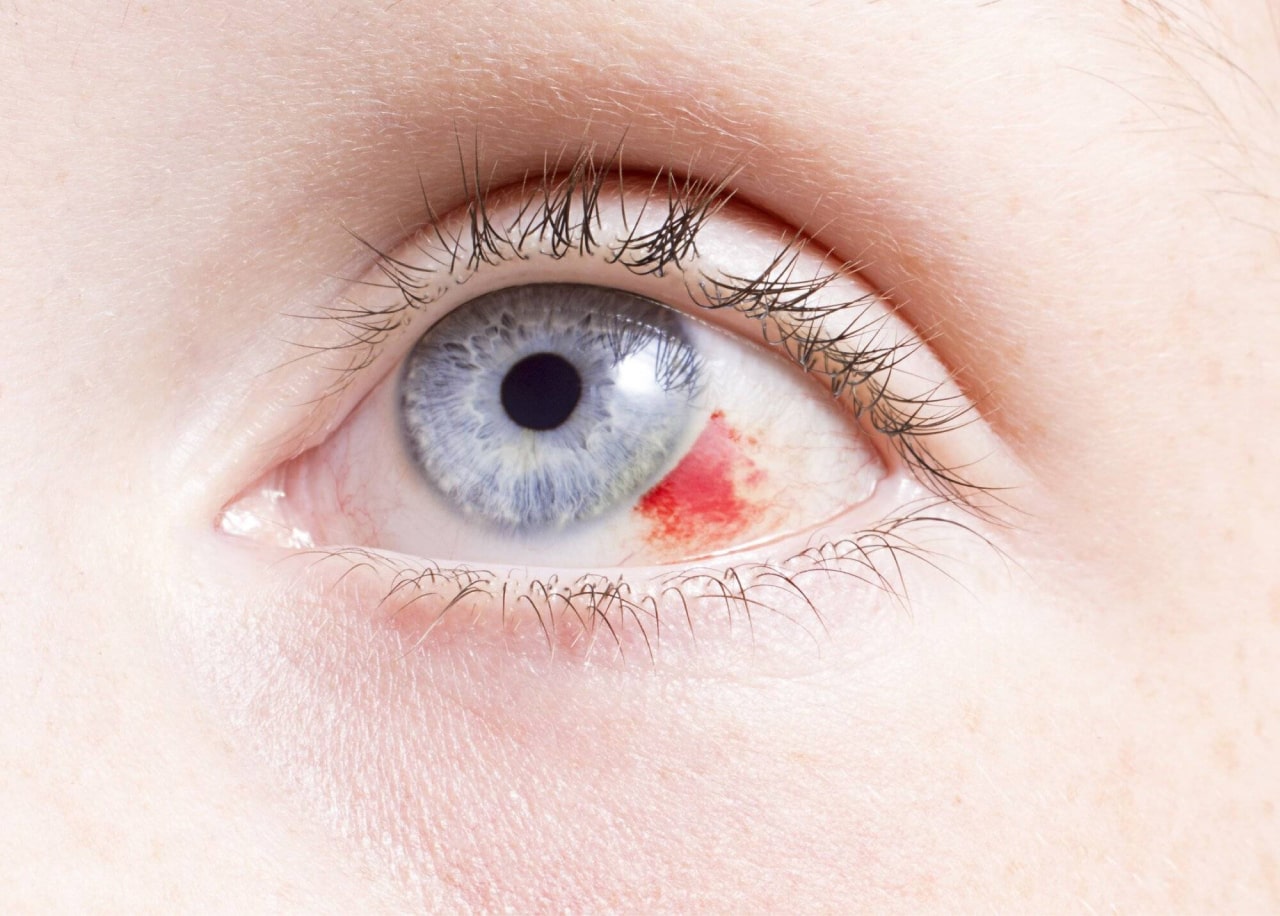 Гематома глаза лечение
