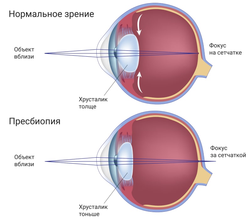 1 это нормальное зрение. Аккомодация глаза. Двойная аккомодация. Нормальное зрение и дальнозоркость. Аккомодация глаза схема.