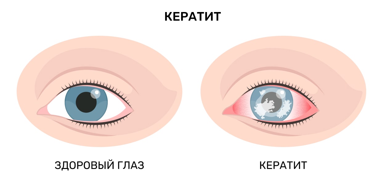 При болезни почему болят глаза: причины и способы облегчения