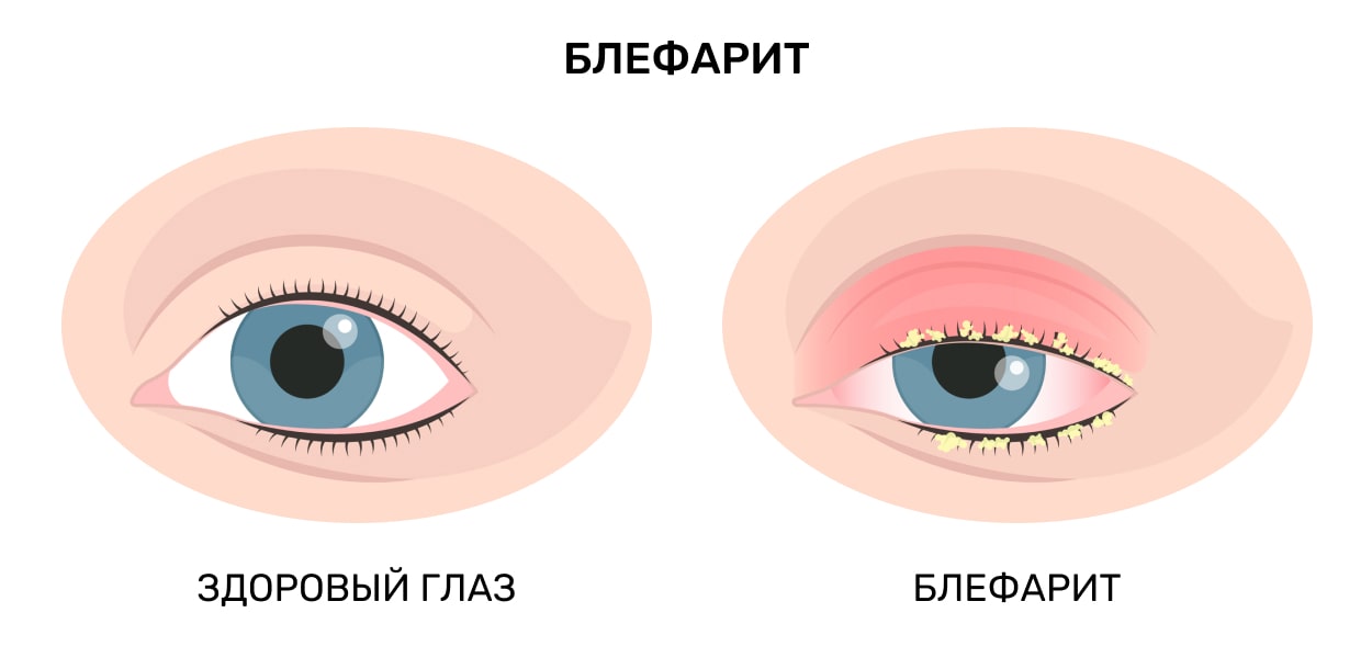 Воспаление роговицы глаза: симптомы и лечение