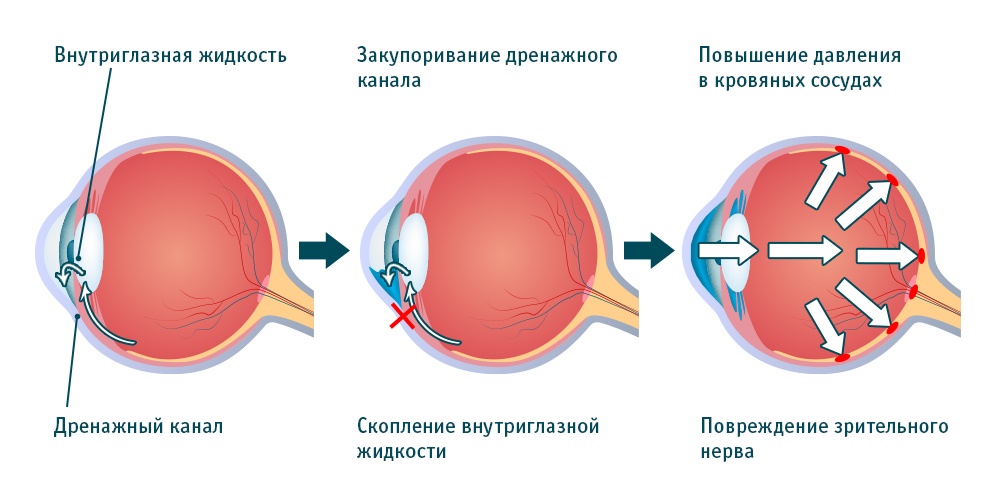 причины развития глаукомы