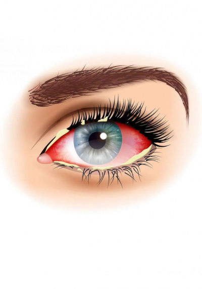 Инфекции глаз: какие бывают и как лечить?