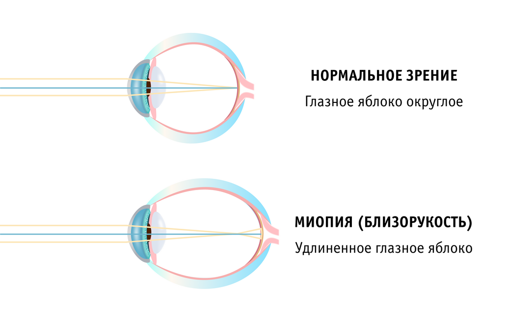 Миопия.jpg